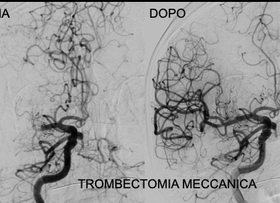 Stroke Team, Asl Viterbo: "A Belcolle superati i 150 pazienti con ischemia cerebrale trattati con tecniche di radiologia interventistica neurovascolare"