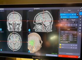 Operativa la rete interaziendale tra le Asl di Viterbo e Roma 4 per la gestione integrata dei pazienti con tumore cerebrale