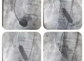 Asl Viterbo: prima valvuloplastica aortica eseguita a Belcolle